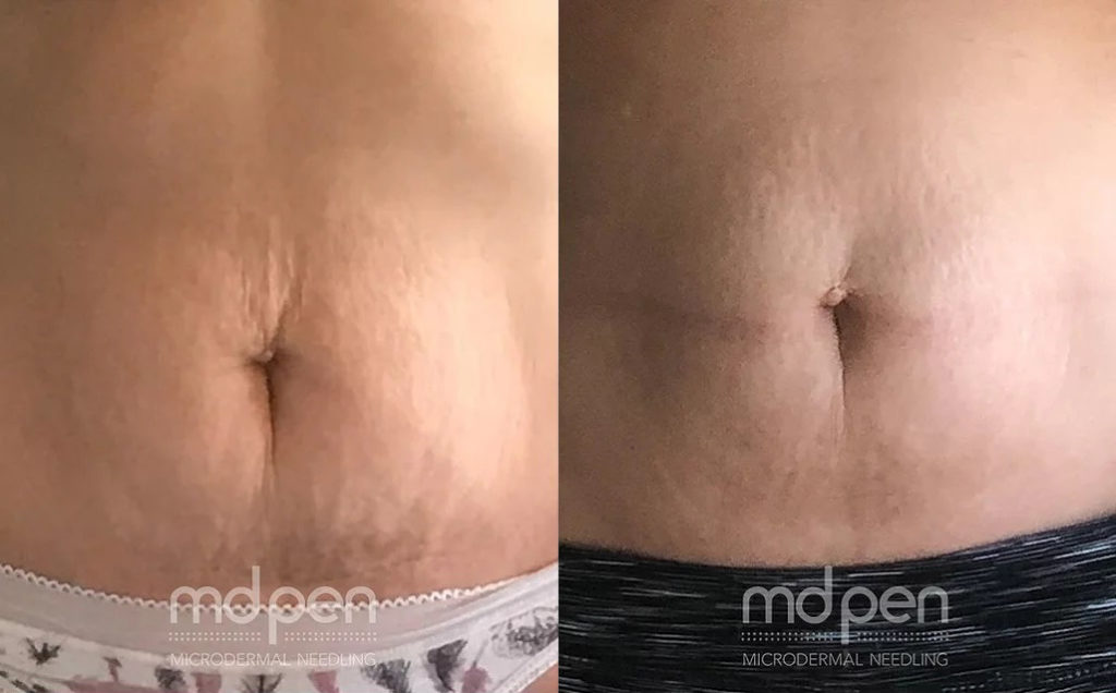 MDPen® Microneedling Before and After Photo by Dr. White in Charlotte North Carolina