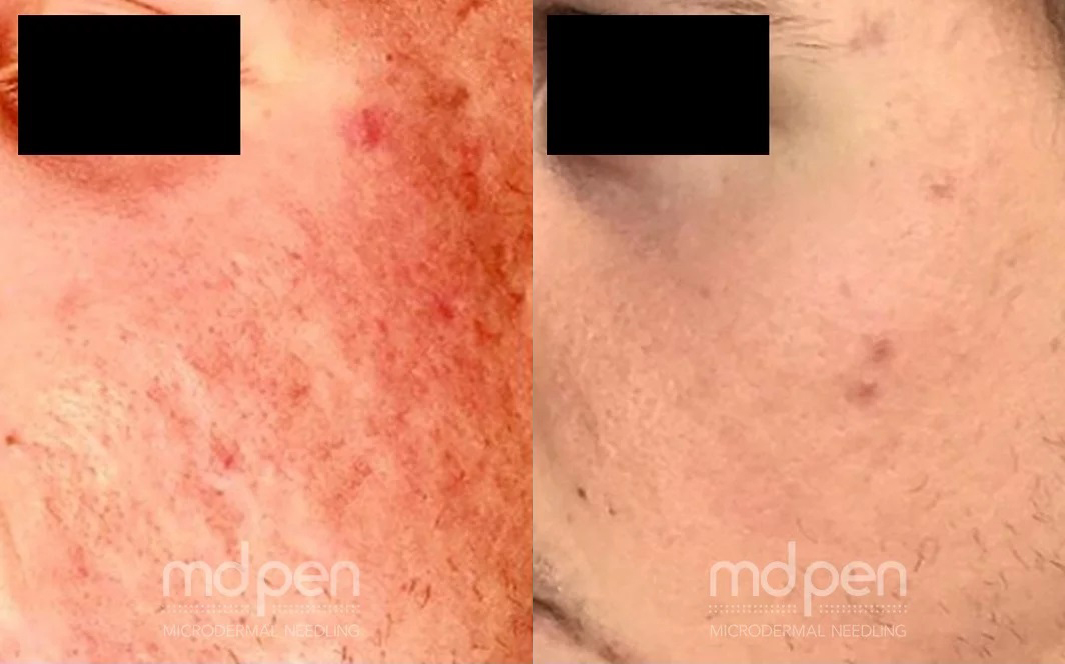 MDPen® Microneedling Before and After Photo by Dr. White in Charlotte North Carolina