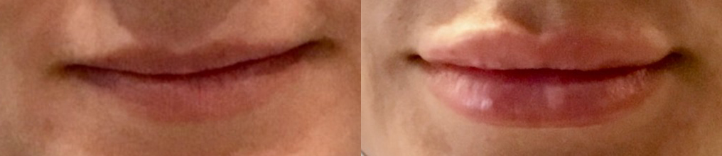 Dermal Fillers Before and After Photo by Dr. White in Charlotte North Carolina