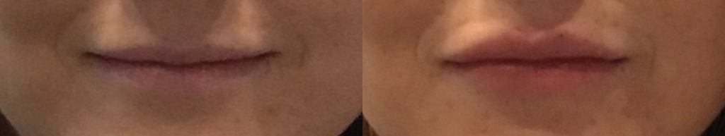 Dermal Fillers Before and After Photo by Dr. White in Charlotte North Carolina
