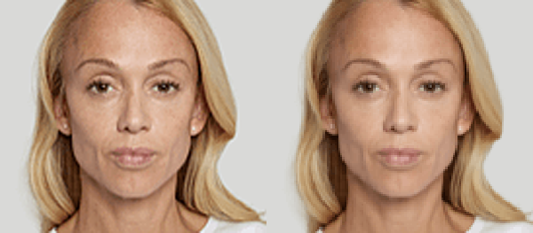 Sculptra® Aesthetic Before and After Photo by Dr. White in Charlotte North Carolina
