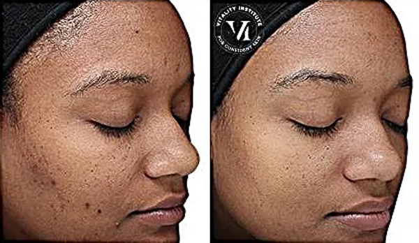 VI Peel Before and After Photo by Dr. White in Charlotte North Carolina