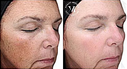VI Peel Before and After Photo by Dr. White in Charlotte North Carolina