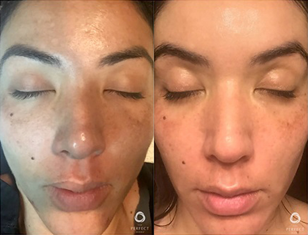 The Perfect™ Derma Peel Before and After Photo by Dr. White in Charlotte North Carolina