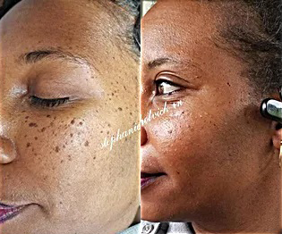 Skin Classic Before and After Photo by Dr. White in Charlotte North Carolina