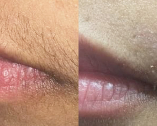 Laser Hair Removal Before and After Photo by Dr. White in Charlotte North Carolina