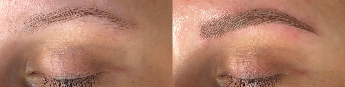 Microblading Before and After Photo by Dr. White in Charlotte North Carolina