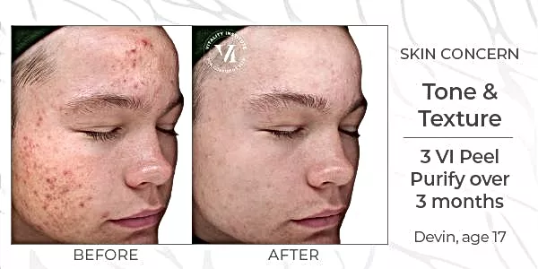 Vi Peel Before and After Photo