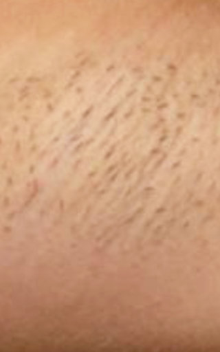 Laser Hair Removal Before and After Photo by Dr. White in Charlotte, NC 