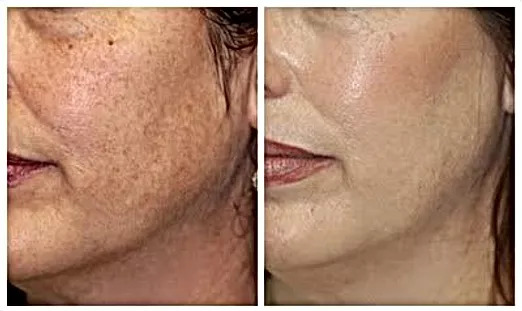 Microdermabrasion Before and After Photo by Dr. White in Charlotte, NC 
