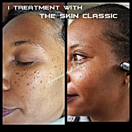 Skin Classic Before and After Photo by Dr. White in Charlotte, NC 
