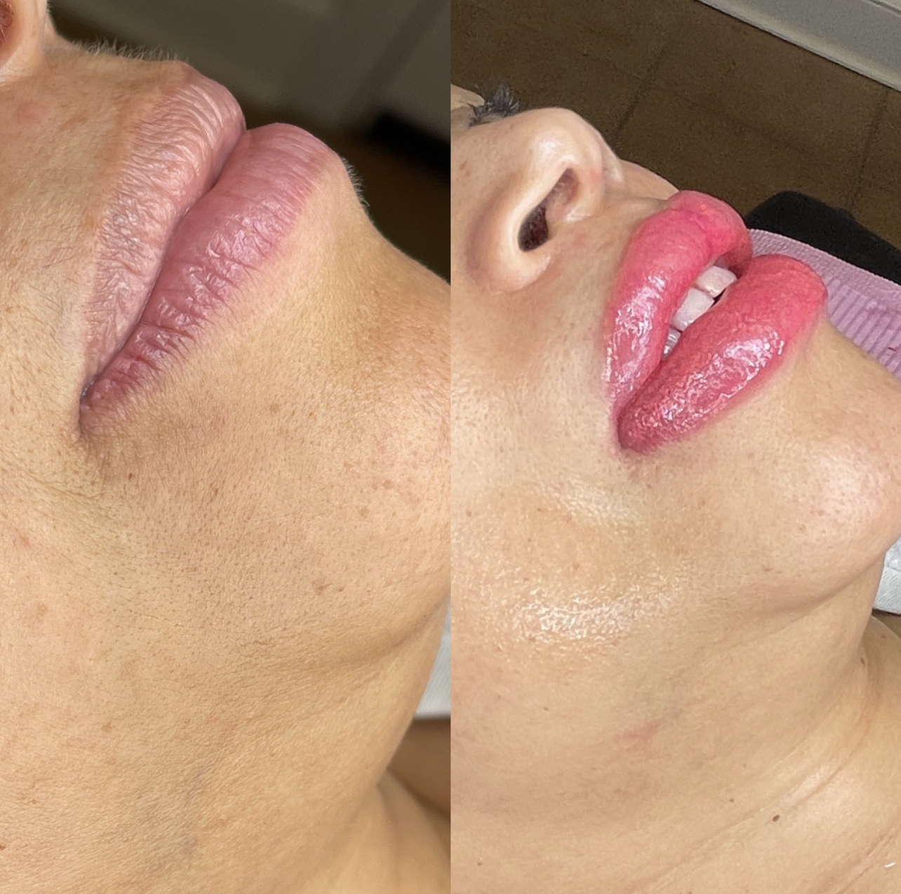 Lip Blushing & Lip Liner Before and After Photo by Dr. White in Charlotte North Carolina