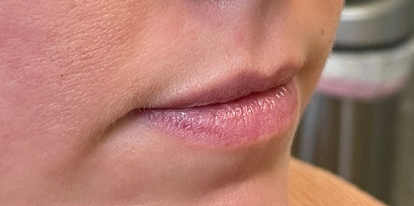 Dermal Fillers Before and After Photo by Dr. White in Charlotte, NC 