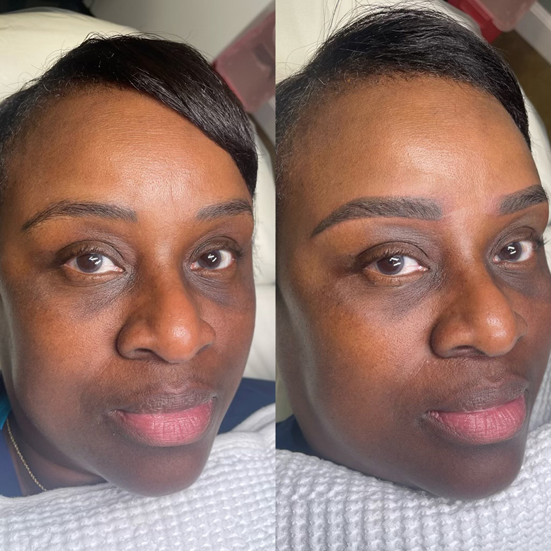 Permanent Makeup Before and After Photo by Dr. White in Charlotte North Carolina