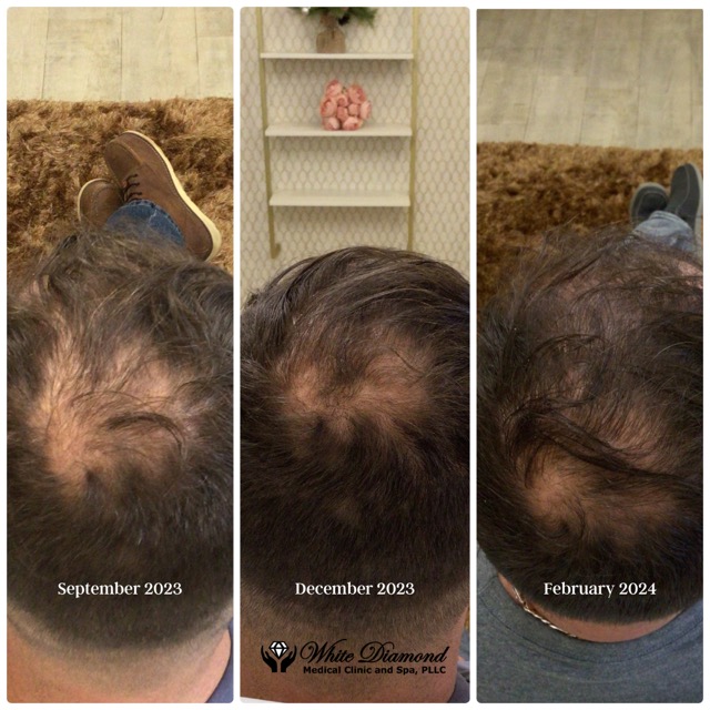PRP Hair Restoration Before and After Photo by Dr. White in Charlotte North Carolina